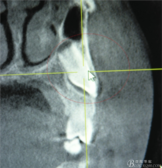 CBCT可以使拔牙更微創(chuàng)