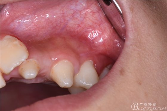 CBCT可以使拔牙更微創(chuàng)