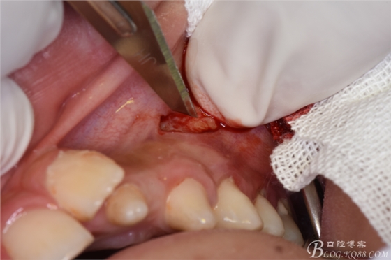 CBCT可以使拔牙更微創(chuàng)