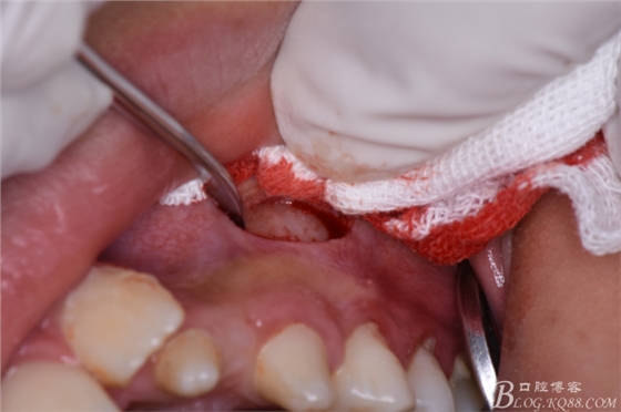 CBCT可以使拔牙更微創(chuàng)