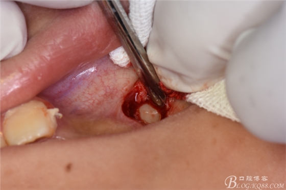 CBCT可以使拔牙更微創(chuàng)