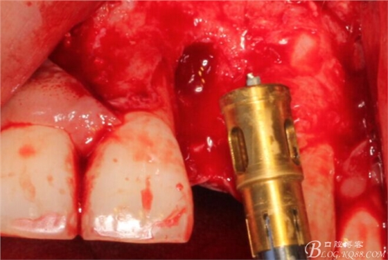 一例上前牙種植失敗病例的補(bǔ)救（梁光強(qiáng)）