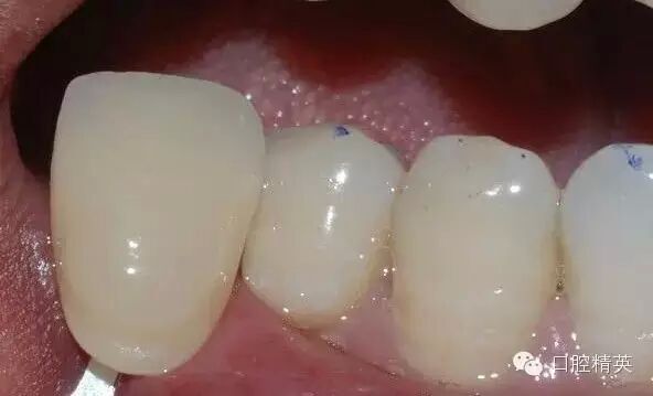 后牙烤瓷橋備牙全過(guò)程