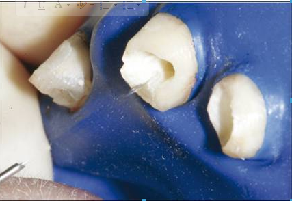 后牙烤瓷橋備牙全過程 后牙烤瓷橋備牙全過程