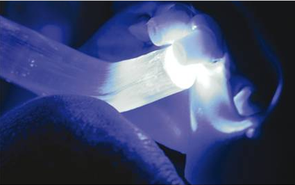 后牙烤瓷橋備牙全過程 后牙烤瓷橋備牙全過程