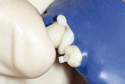 后牙烤瓷橋備牙全過程 后牙烤瓷橋備牙全過程