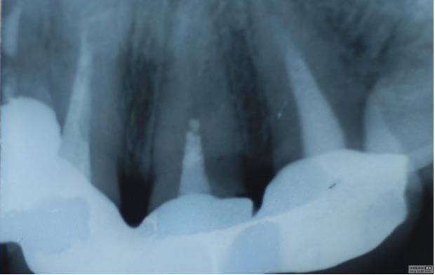 認(rèn)真看待根管治療在醫(yī)院診所技術(shù)中的地位 認(rèn)真看待根管治療在醫(yī)院診所技術(shù)中的地位