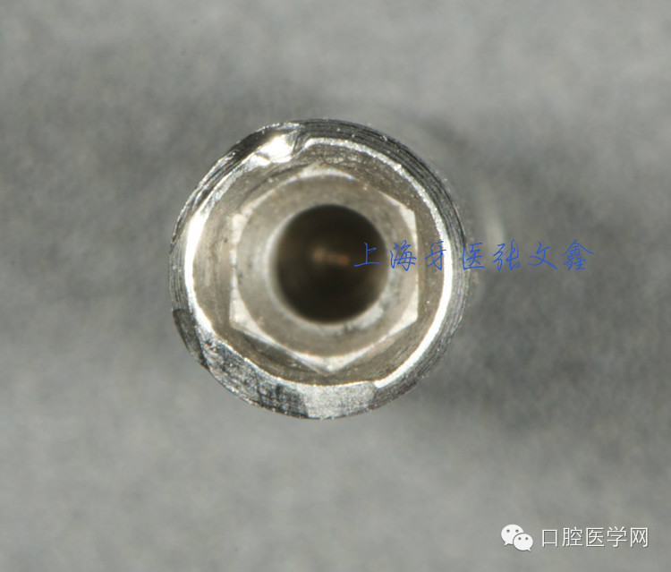 種植替代體上的細(xì)節(jié)不可忽視 種植替代體上的細(xì)節(jié)不可忽視