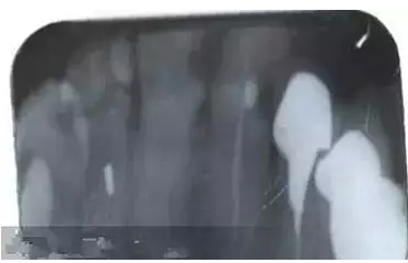 根管治療中斷針及處理方法 根管治療中斷針及處理方法