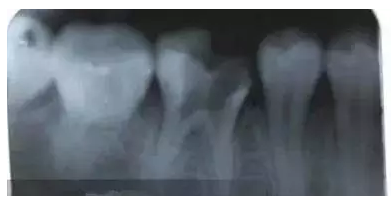 根管治療中斷針及處理方法 根管治療中斷針及處理方法