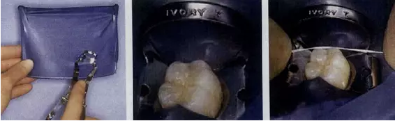 橡皮障的四種安裝方法以及疑難處理 橡皮障的四種安裝方法以及疑難處理