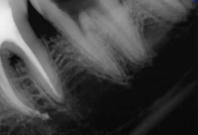 牙醫(yī)的&ldquo;癢癢&rdquo;&mdash;&mdash; 斷針