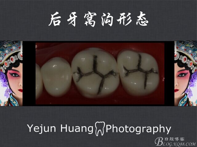 黃葉君：淺談口腔固定修復(fù)流程]第四期：后牙的預(yù)備流程