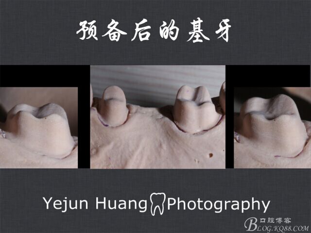 黃葉君：淺談口腔固定修復(fù)流程]第四期：后牙的預(yù)備流程