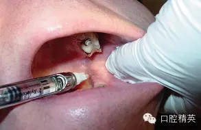 口腔局部麻醉并發(fā)癥及臨床處理 口腔局部麻醉并發(fā)癥及臨床處理