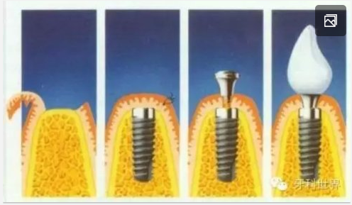 種植【最全的種植牙介紹】 種植【最全的種植牙介紹】