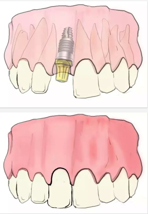 種植【最全的種植牙介紹】 種植【最全的種植牙介紹】