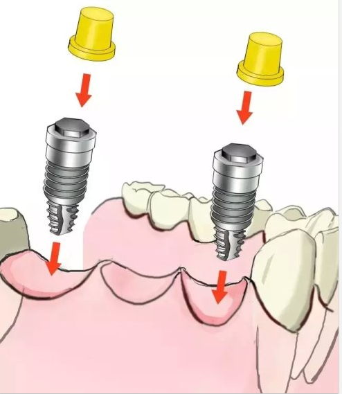 種植【最全的種植牙介紹】 種植【最全的種植牙介紹】