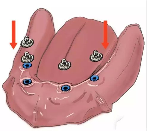 種植【最全的種植牙介紹】 種植【最全的種植牙介紹】