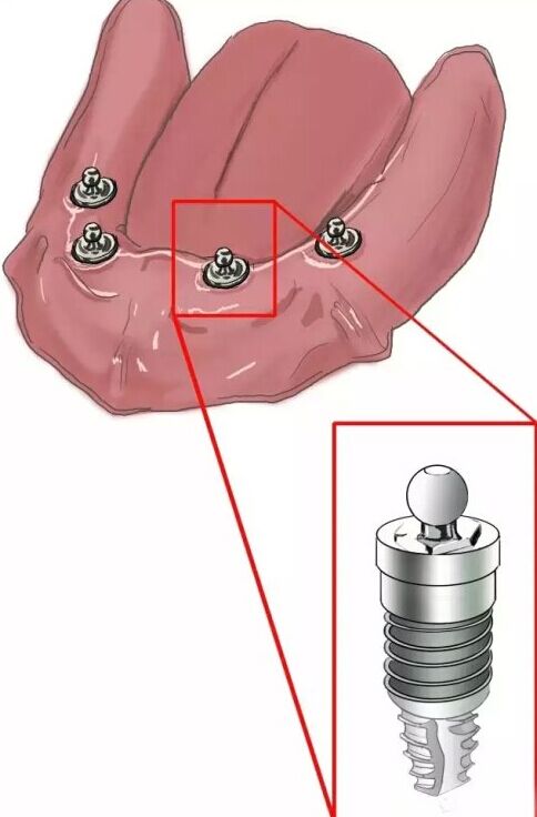 種植【最全的種植牙介紹】 種植【最全的種植牙介紹】