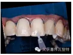 義獲嘉貼面粘接的操作步驟！