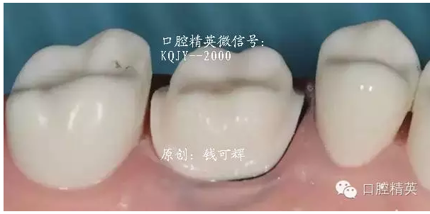 為什么你的牙齒備不好 為什么你的牙齒備不好