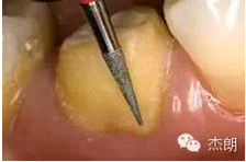 即刻牙本質(zhì)封閉 即刻牙本質(zhì)封閉