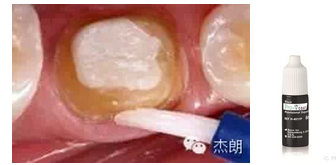 即刻牙本質(zhì)封閉 即刻牙本質(zhì)封閉