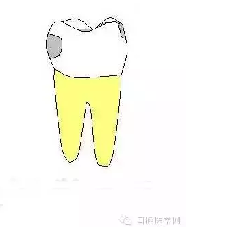 齲齒齲洞的5種類型 齲齒齲洞的5種類型