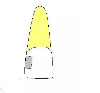 齲齒齲洞的5種類型 齲齒齲洞的5種類型