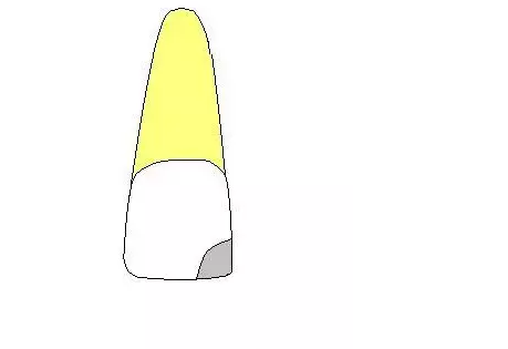 齲齒齲洞的5種類型 齲齒齲洞的5種類型