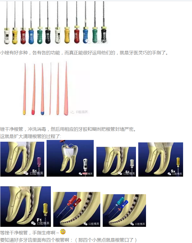 根管治療 根管治療