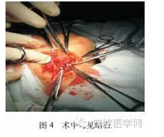 下頜下靜脈畸形伴多發(fā)靜脈石誤診為涎石病1例 下頜下靜脈畸形伴多發(fā)靜脈石誤診為涎石病1例