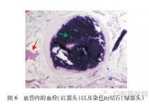 下頜下靜脈畸形伴多發(fā)靜脈石誤診為涎石病1例 下頜下靜脈畸形伴多發(fā)靜脈石誤診為涎石病1例