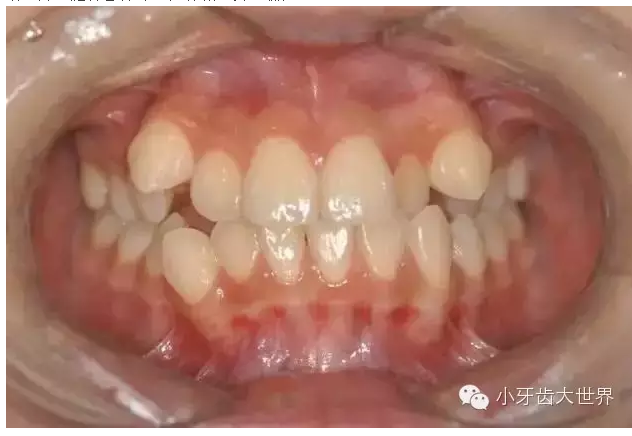 “地包天”的最佳治療時(shí)間 “地包天”的最佳治療時(shí)間