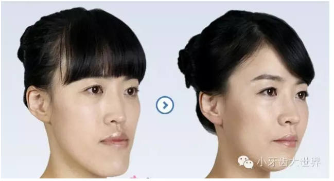 “地包天”的最佳治療時(shí)間 “地包天”的最佳治療時(shí)間