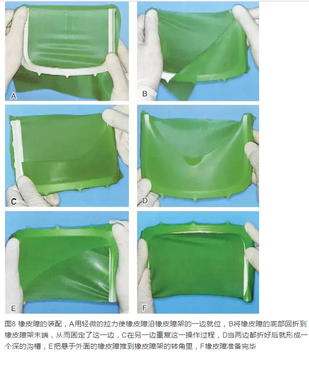 橡皮障隔離之單顆牙隔離方法——陳智教授 橡皮障隔離之單顆牙隔離方法——陳智教授