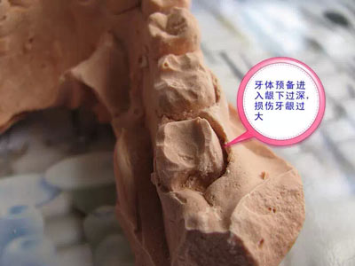 備牙應(yīng)注意的事項(xiàng)+備牙取摸損傷牙齦問(wèn)題