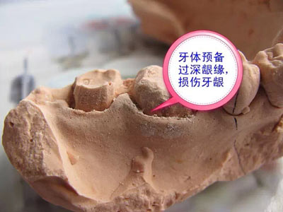 備牙應(yīng)注意的事項(xiàng)+備牙取摸損傷牙齦問(wèn)題