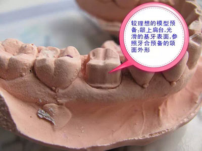 備牙應(yīng)注意的事項(xiàng)+備牙取摸損傷牙齦問(wèn)題