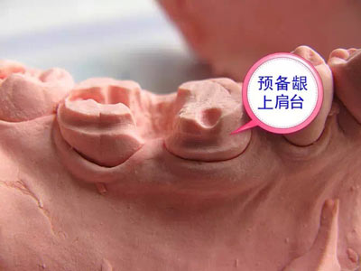 備牙應(yīng)注意的事項(xiàng)+備牙取摸損傷牙齦問(wèn)題