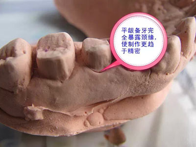 備牙應(yīng)注意的事項(xiàng)+備牙取摸損傷牙齦問(wèn)題