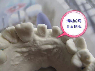 備牙應(yīng)注意的事項(xiàng)+備牙取摸損傷牙齦問(wèn)題