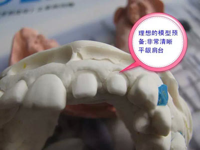 備牙應(yīng)注意的事項(xiàng)+備牙取摸損傷牙齦問(wèn)題