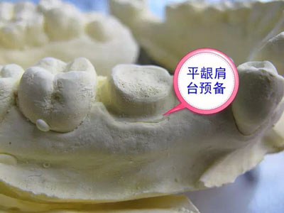 備牙應(yīng)注意的事項(xiàng)+備牙取摸損傷牙齦問(wèn)題