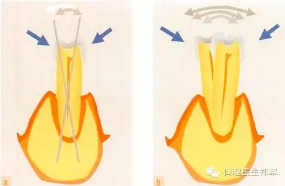 牙周炎的相關(guān)修復(fù)治療原則 牙周炎的相關(guān)修復(fù)治療原則
