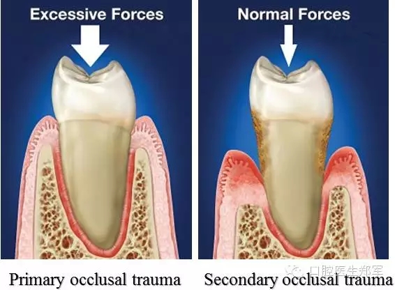 牙周炎的相關(guān)修復(fù)治療原則 牙周炎的相關(guān)修復(fù)治療原則