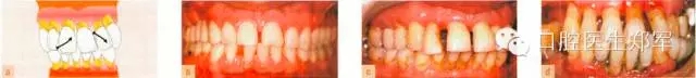 牙周炎的相關(guān)修復(fù)治療原則 牙周炎的相關(guān)修復(fù)治療原則