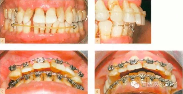 牙周炎的相關(guān)修復(fù)治療原則 牙周炎的相關(guān)修復(fù)治療原則