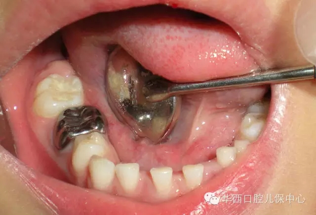 【華西兒牙專欄】給孩子的牙齒戴個(gè)安全帽&mdash;&mdash; 金屬預(yù)成冠